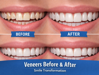 How Much Do Veneers Cost?